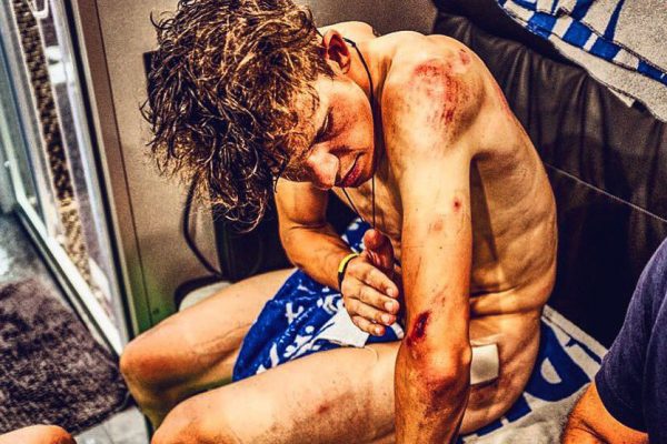 Ποδηλάτης του Tour de France παρουσιάζει τις πληγές του (pic)